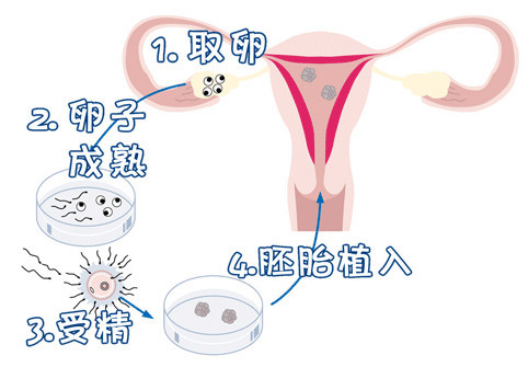無精症